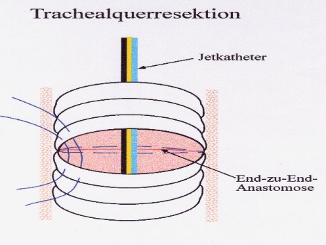 End-zu-End-Anastomose