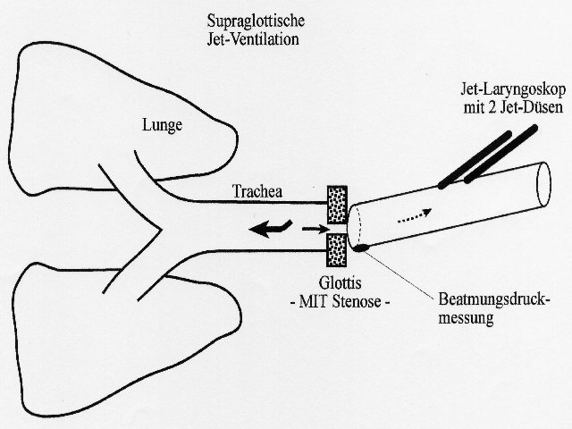Gasapplikation oberhalb der Stenose