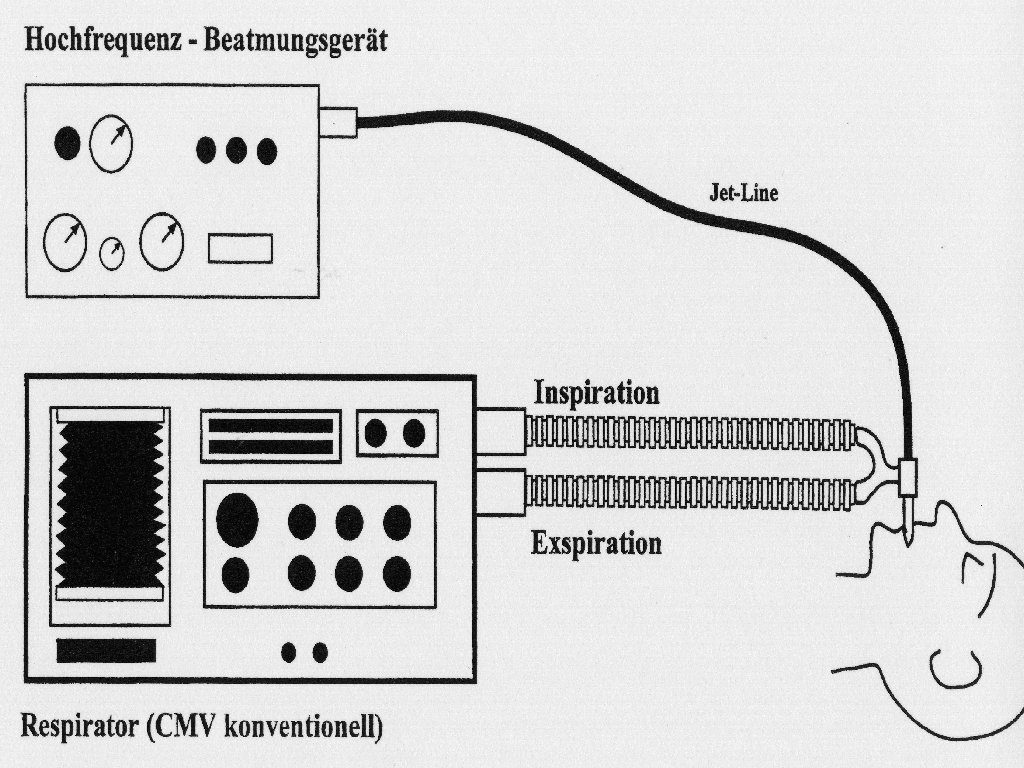 Geräte für eine kombinierte Hochfrequenzbeatmung