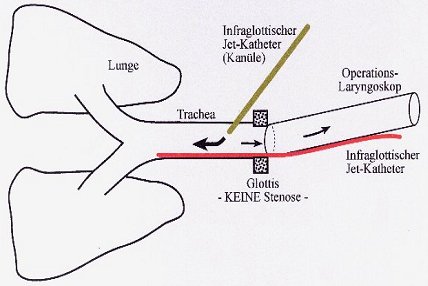 Infraglottische Jet-Ventilation