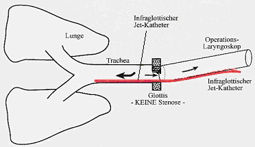 Jetkatheters bei transoraler Jetventilation