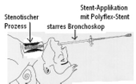 Polyflex-Stent