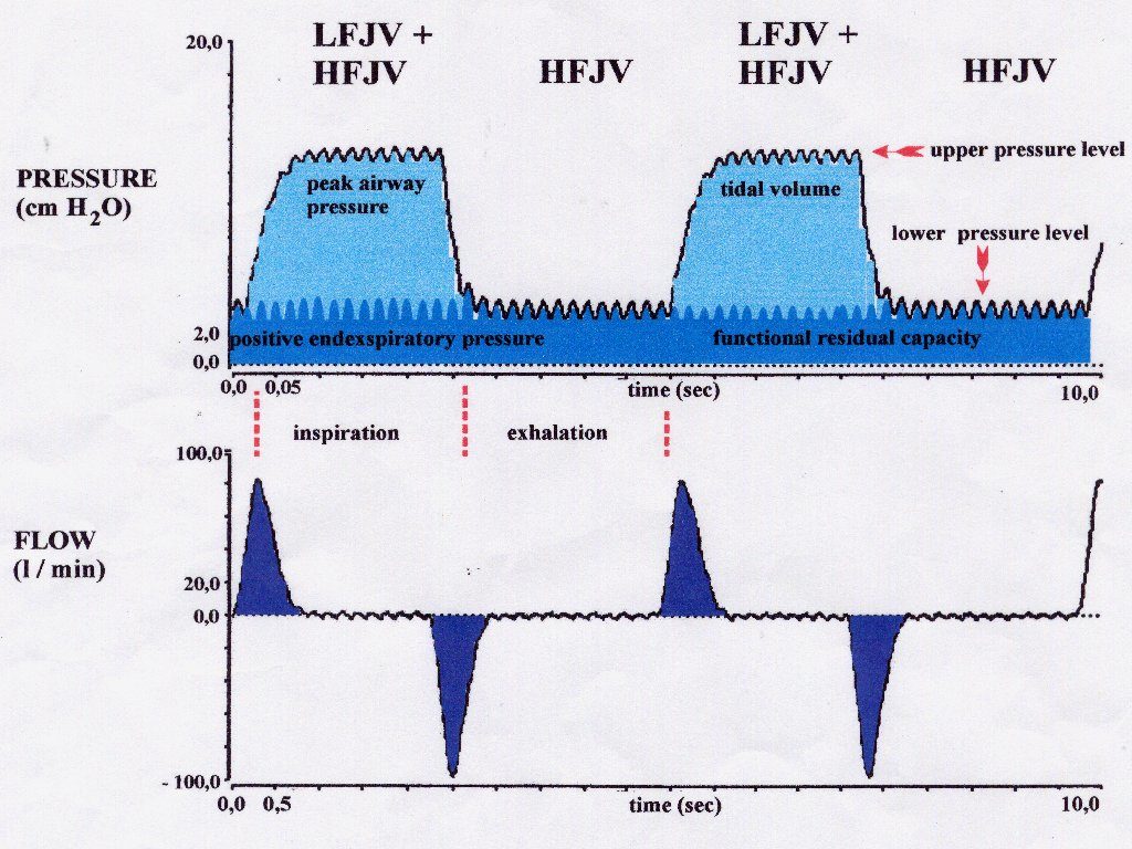 SUPERPONIERTE HOCHFREQUENZ-JET-VENTILATION