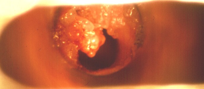Schwere Larynxpapillomatose