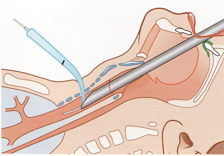 Tracheotomie-Endoskop