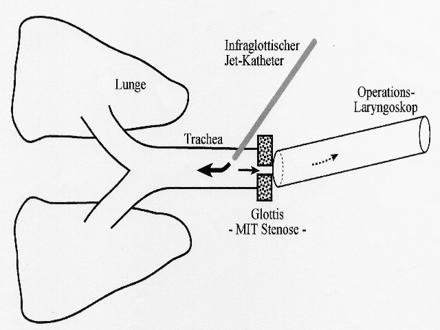 Transkrikoidalen Plazierung des Jet-Katheters